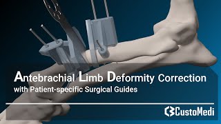 Antebrachial limb deformity correction with patientspecific surgical guides [upl. by Horowitz]