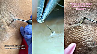 Releasing an Ingrown Hair [upl. by Heilman]