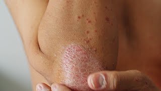 What Is Plaque Psoriasis [upl. by Hetti]