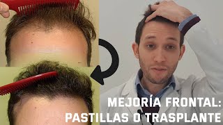 DERMATÓLOGO explica cómo mejorar la ALOPECIA ANDROGÉNICA FRONTAL [upl. by Lebasiram]