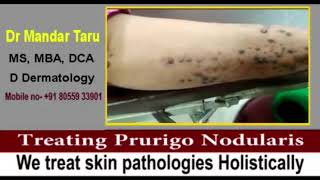 Treating Prurigo Nodularis skin condition [upl. by Edbert59]