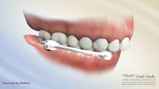 Carriere Distalizer WIth Lower Lingual Arch  Orthodontic Appliance [upl. by Dnamron]