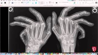 Introduction to Imaging of Arthritis [upl. by O'Carroll]