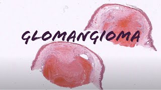 GlomangiomaGlomuvenous Malformation glomus tumor with lots of vessels pathology dermatology [upl. by Eiramanel531]