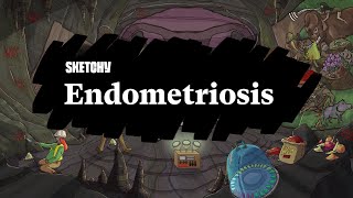 Endometriosis Lesson Full Lesson  Sketchy Medical  USMLE Step 2 CK [upl. by Ambrogio]