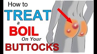 How to TREAT a BOIL on Your BUTTOCKS 3 Simple Steps  Best TREATMENT For BOILS On Your Buttocks [upl. by Senior235]