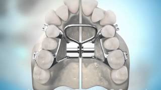 Surgically Assisted Palatal Expansion [upl. by Yanad]