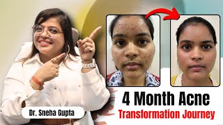 best treatment for acne and acne scars  get rid of acne scars and pigmentationDrSnehaGuptaMD [upl. by Eelibuj]