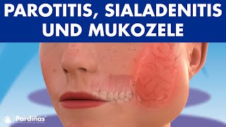 MUMPS Parotitis und andere Speicheldrüsenprobleme Sialadenitis Sialolithiasis Mukozele © [upl. by Eet]