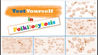 Review 📝  RBCs Morphological Abnormalities Poikilocytosis [upl. by Nimar]