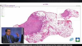 Lung Granulomas Caused by Fungal Infection [upl. by Riem156]