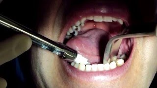 Sialolitiasis Obstrucción de Glándula Salival [upl. by Nnomae18]