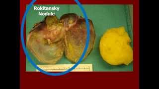 Mature Ovarian Teratoma incidental [upl. by Halsy482]