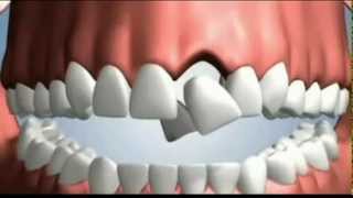 4 Options to Replace a Tooth [upl. by Dukie]