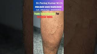 Foam Sclerotherapy treatment for varicose veins Varicose veins treatment before SSC GD medical [upl. by Anirual]