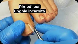 Rimedi per unghia incarnita Come applicare il cotone sotto lunghia incarnita [upl. by Syramad]