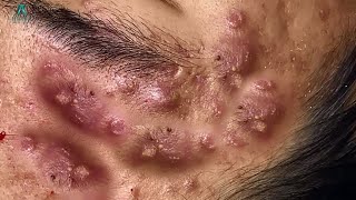 Big Cystic Acne Blackheads Extraction Blackheads amp Milia Whiteheads Removal Pimple Popping [upl. by Nollad]