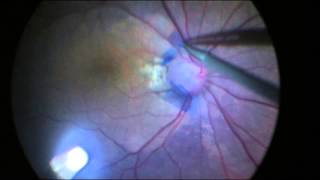 Surgical Treatment of Optic pit maculopathy [upl. by Remot]