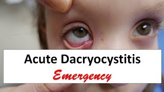 Acute Dacryocystitis Emergency [upl. by Soren264]