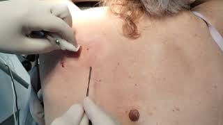 Nevus Electrocoagulation [upl. by Anelad]