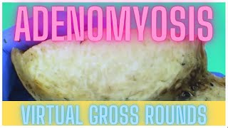 Hysterectomy for Adenomyosis Gross Pathology [upl. by Delogu]