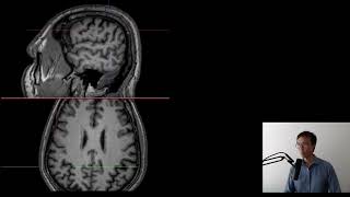 Sulco ParietoOccipital no Plano Axial [upl. by Gwendolen]