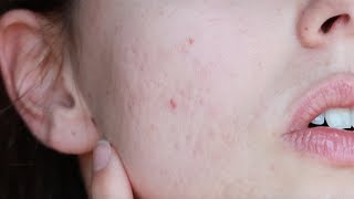 ACNE DIARY Settimo Mese con Isotretinoina LA FINE [upl. by Ycrep555]