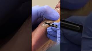 quotProfessional Callus Removal But Will They Come Back [upl. by Boff]