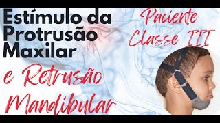 Pacientes classe III  Protrusão maxilar e retrusão mandibular Aula 106 [upl. by Yumuk]