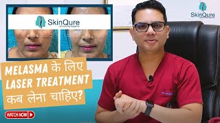 Best Treatment for Melasma  Laser Treatment for Melasma in Delhi  SkinQure  Dr Jangid [upl. by Reinnej23]