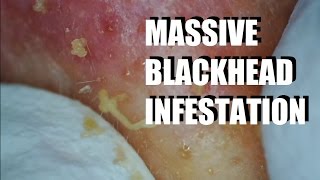 Horrible Blackhead infestion in my sick friend [upl. by Rogovy604]