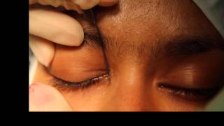 Lacrimal probing and syringing [upl. by Inafit]