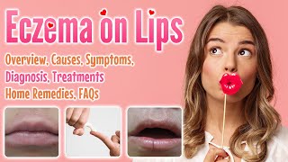 Eczema on lips causes symptoms treatment remedies FAQ  remake Lip dermatitis [upl. by Qerat96]