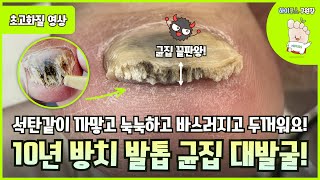 10년간 석탄같이 변해버린 발톱 완벽 말끔케어  Ingrown toenail  toenail fungus  athletes foot [upl. by Gilberte]