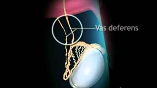 Vasectomy Surgery  How the Vasectomy Procedure is Performed [upl. by Ahsimek]