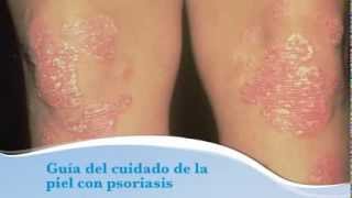 Guia del cuidado de la piel con psoriasis [upl. by Kurth486]