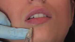 Lippenunterspritzung mit Juvederm Volbella  PULLMANN [upl. by Chip]