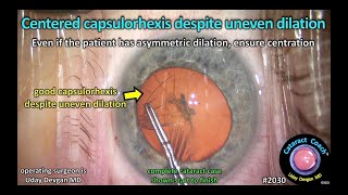 CataractCoach™ 2030 centered capsulorhexis despite uneven dilation [upl. by Maidel]