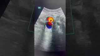 Así se ve una disección aórtica abdominal en ultrasonido doppler cirugiavascular vasculardisease [upl. by Kcyred587]