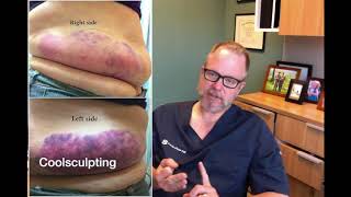 Sculpsure vs Coolsculpting  Which One is Better [upl. by Eelyahs]