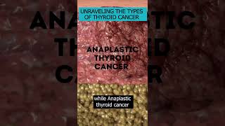 Various types of thyroid cancer and how they impact prognosis and treatment ThyroidCancer [upl. by Suriaj]