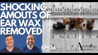 SHOCKING AMOUNTS OF EAR WAX REMOVED  EP934 [upl. by Carola]