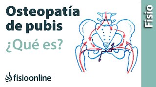 Pubalgia u osteopatía de pubis  Qué es causas síntomas y tratamiento [upl. by Eanej214]