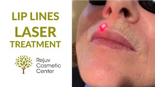 Lip Lines Sciton LaserTreatment Rejuv Cosmetic Center NJ [upl. by Yirinec964]