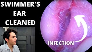 Swimmers Ear Cleaned With Suction Outer Ear Infection [upl. by Anirtep]