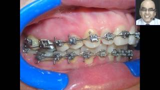 Pegado de Brackets y Tubos en las Tecnicas Individualizadas 2 [upl. by Hoem]