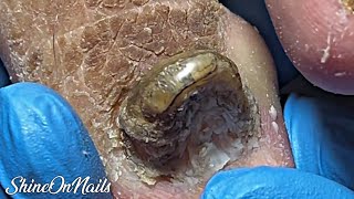 EXTREME Toenail Trimming Thick Overgrown amp Ungroomed ShineOnNails [upl. by Allix]