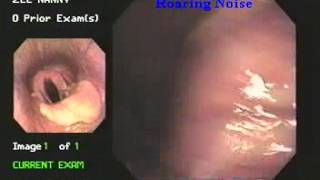 roaring disease laryngeal hemiplegiaby endoscopy [upl. by Chimene]