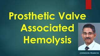 Prosthetic Valve Associated Hemolysis [upl. by Dlonra]