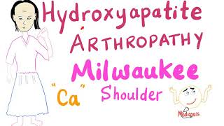 Hydroxyapatite Arthropathy  Milwaukee Soulder [upl. by Furnary217]